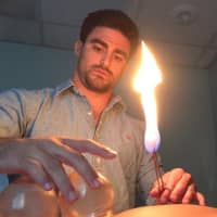 <p>Peter DeCicco of treats a patient with cupping therapy.</p>