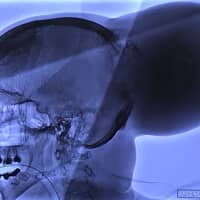 <p>A scan of De La Villa&#x27;s tumor</p>