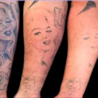 <p>Tattoo removal by Clean Slate Laser in Wayne.</p>