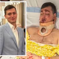 DC Bartender Broke Nearly Every Bone In His Face In Crash He Can't Remember, Brother Says