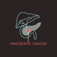 Pancreatic Cancer: Trying To Outwit A Killer