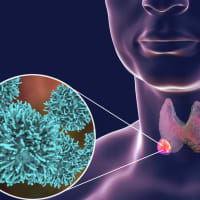 Thyroid Cancer: A Rising Trend But Minimal Threat