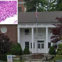 Parasitic Infection Exposure Warning Issued For Events Held In Mount Kisco: Officials