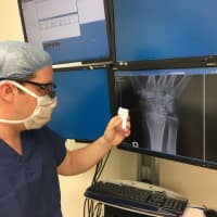 <p>Dr. Vitale uses patient-specific, 3D printed templates to guide surgical implant placement to realign a previously fractured wrist which healed in a misaligned position.</p>