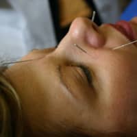 Wilton Acupuncturist Touts Its Preventative Health Benefits