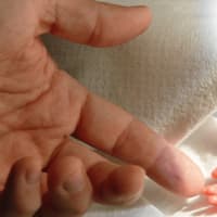 <p>Dante Esposito&#x27;s father reaches out to the hand of his son when he was born prematurely in 2003.</p>