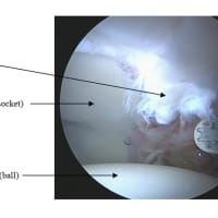 <p>Figure 2: Arthroscopic debridement of hip labral tear.</p>