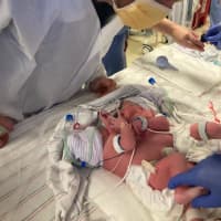 <p>Alabama Pastor Dwight Castle and his newborn conjoined twin daughters.</p>