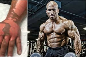 Westchester Bodybuilder Burned By Exploding Cooking Spray; Support Surges