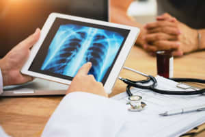 See Inside Your Lung Cancer Risk