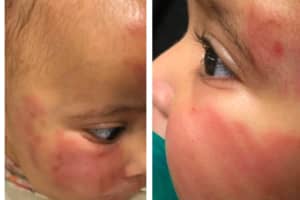 Baby Badly Bruised At Unlicensed Newark Daycare, Mom Says