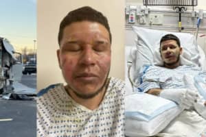 Traveling Barber From Norwich Burned In RV Explosion: 'This Will Be Long Recovery'