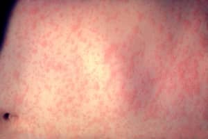 Another Possible Measles Exposure At Newark Airport