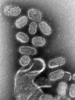 Flu Kills Central Jersey Child