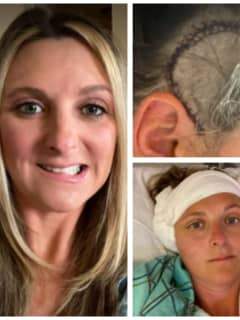 NJ Mom Faces Long Road To Recovery After Brain Tumor Removal