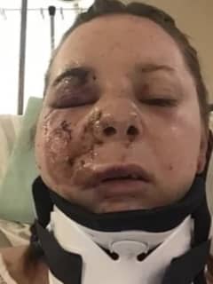 Countless Facial Fractures Among Injuries Suffered By NJ Woman Dragged, Struck By Cars