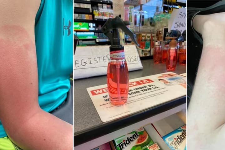 Bergen County Mom: Homemade Hand Sanitizer Sold At Store Burned My Son