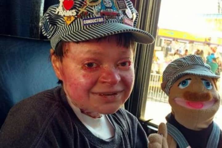 'He Was A Hero': Stafford 23-Year-Old  Dies After Brave Battle With Rare Skin Disorder