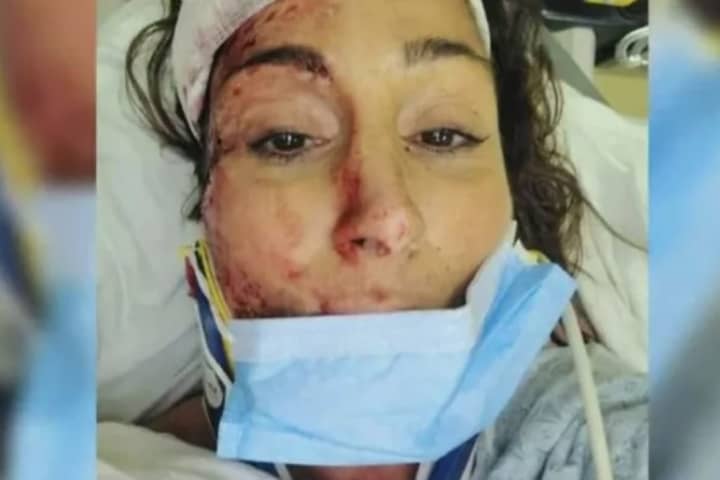 Winchester Spa Owner, Mom Bed-Ridden After Hit By Car Just Before Christmas