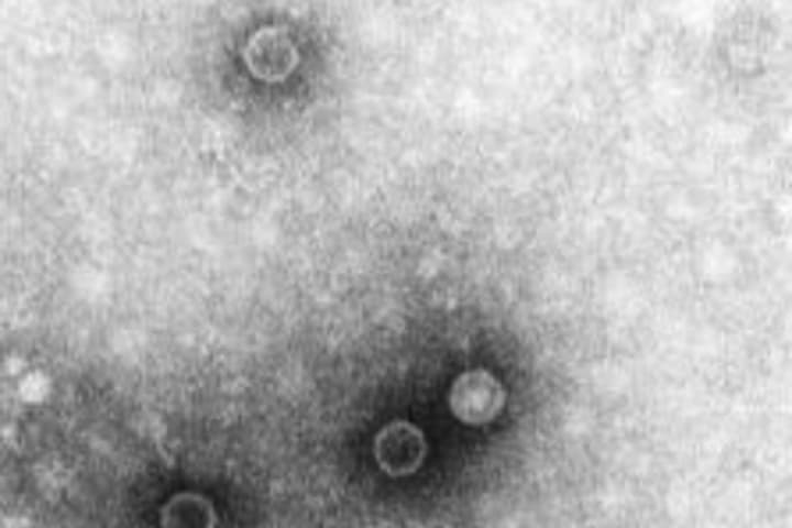 Polio Virus Identified In Wastewater Samples Taken In Two Locations In Hudson Valley