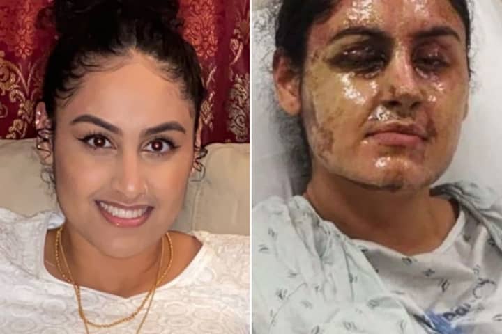 'Have A Heart': Reward Upped In Acid Attack That Left Hofstra Student Disfigured