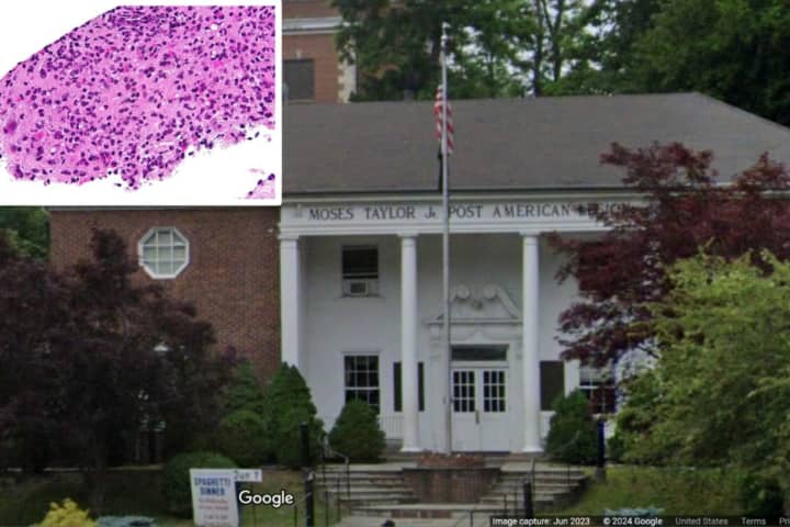 Parasitic Infection Exposure Warning Issued For Events Held In Westchester: Officials