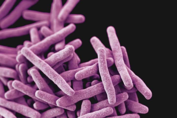 Active Tuberculosis Case Leaves 40 People Exposed At UMass Boston: Officials