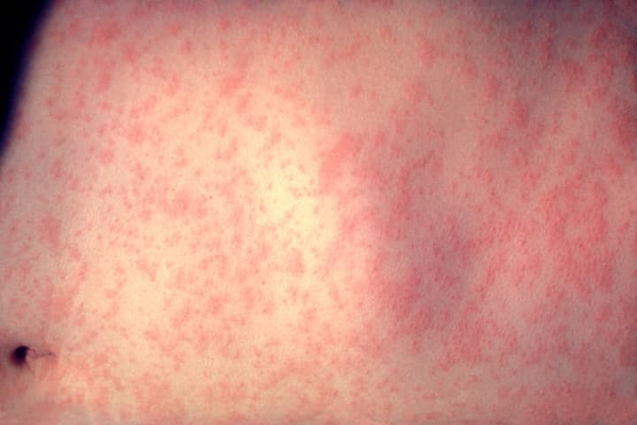Measles Reported In Englewood, Newark Airport: Health Department Warns