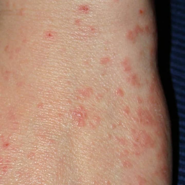 The rash from scabies, which also causes intense itching. A child at a Sullivan County school has been diagnosed with scabies.