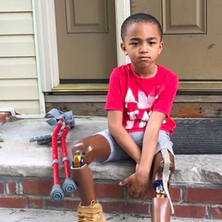 Kayden Kinckles, 6 of Englewood, is just like any other kid his age. The only difference is that he&#x27;s a double leg amputee.