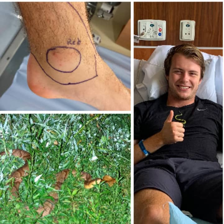 Kevin Murray of Pennington recovers after being bit by a copperhead snake on a hike.