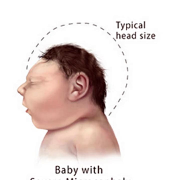 Babies born with severe microcephaly have much smaller heads, resulting in a variety of problems.