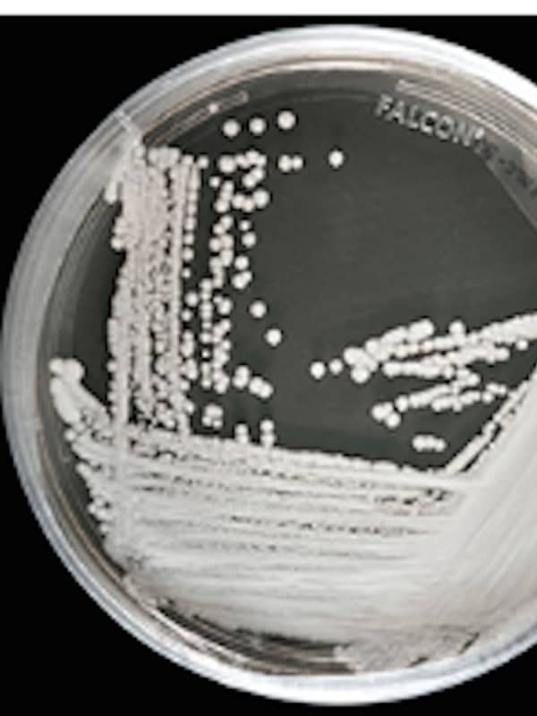 Potentially Deadly Superbug Fungus Sickens More Than 300 In New York