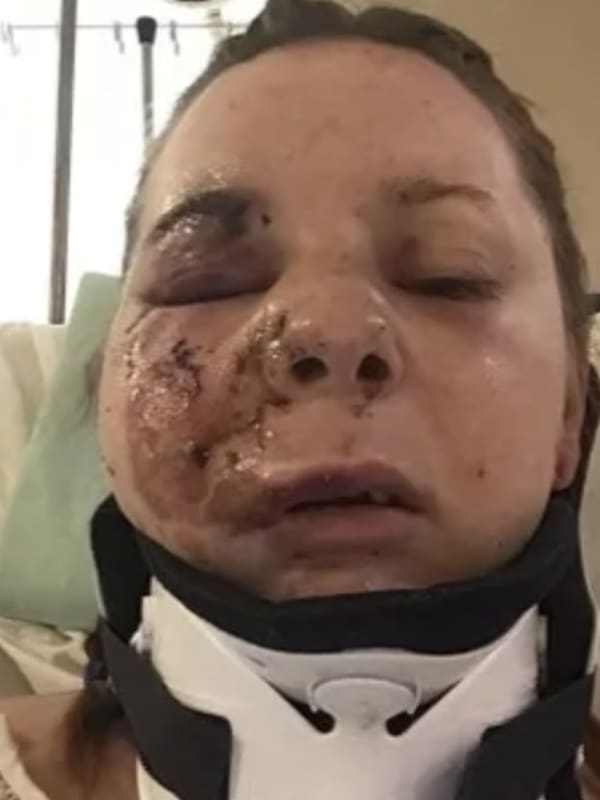Countless Facial Fractures Among Injuries Suffered By Cape May Woman Dragged, Struck By Cars