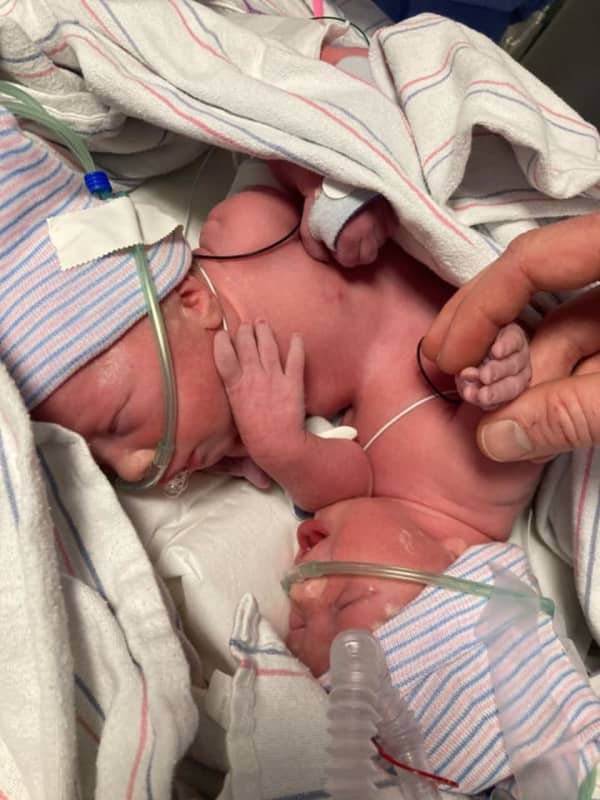 Conjoined Twins From Alabama Born In Philadelphia Hospital (Photos)