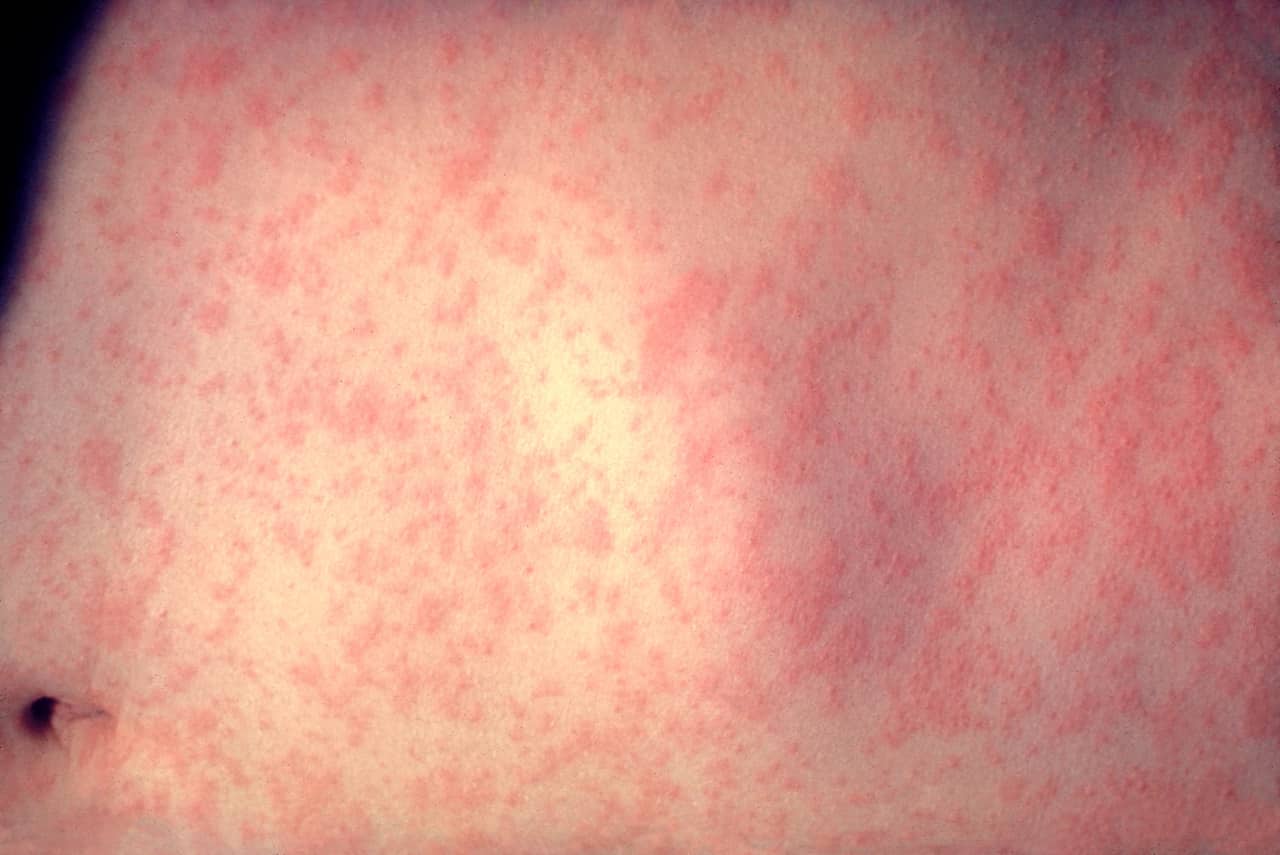 Another person recently arrived at Newark Liberty International Airport with the measles, authorities said.