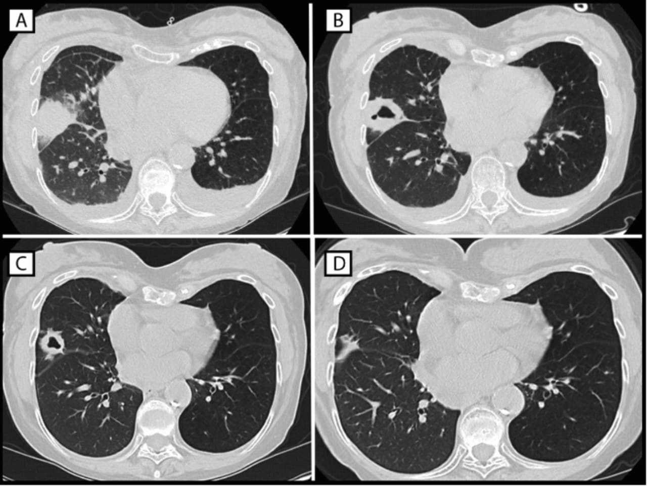 HISTORIC: Legionnaires' First Transplant Patients– 1 Killed In PA, CDC