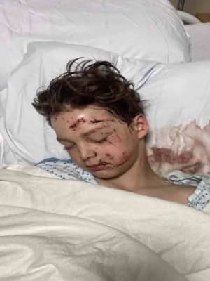 Young Bicyclist Embedded In Windshield In Jersey Shore DUI Crash Faces Long Road To Recovery
