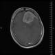 Before surgery at BSSNY, a scan shows a large brain tumor.