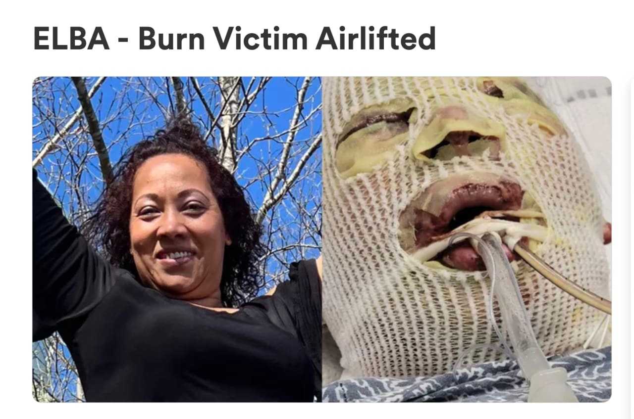 Community Support Grows For Victim Left With Critical Burns From South