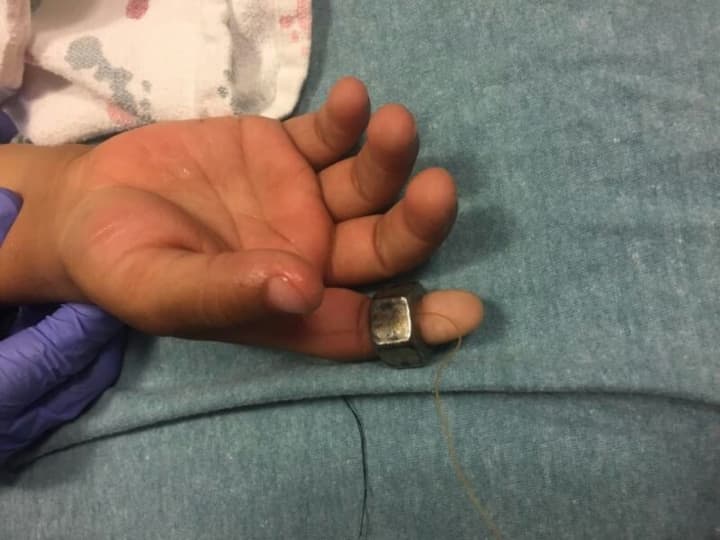 The rescue team from the Stamford Fire Department assisted Stamford Hospital in treating a young boy with a bolt stuck on his finger.