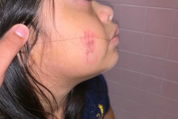 Emily, who has Down syndrome, was bitten in class in Elizabeth.