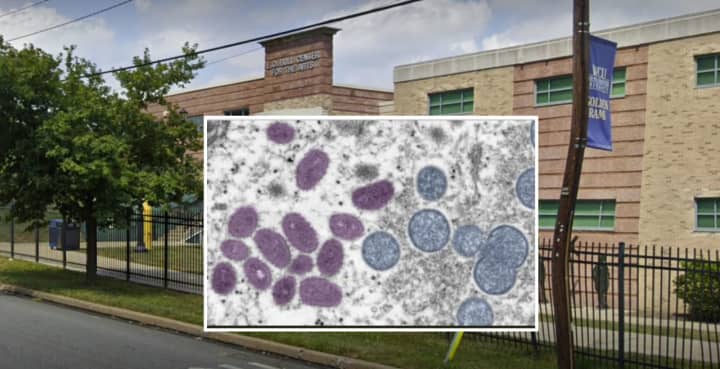 A West Chester University student has tested positive for monkeypox, officials said.