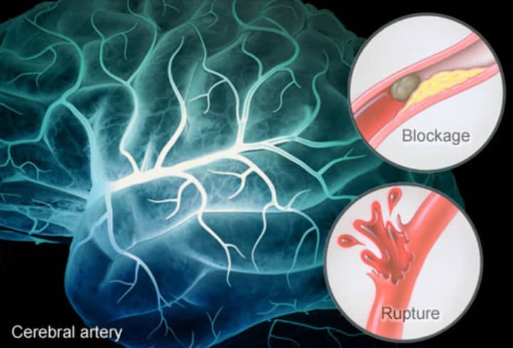 Strokes occur when an artery in the brain is blocked or ruptured. In order to reduce the chance of permanent side effects, it&#x27;s important to immediately seek help.