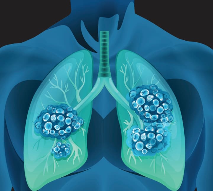Lung cancer is the most deadly form of the disease among women in the United States today. NewYork-Presbyterian is working to help women from diagnosis to survivorship.