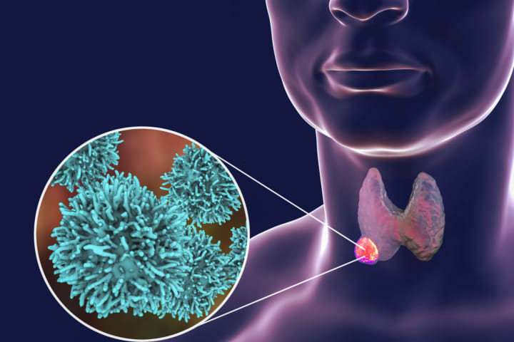 Thyroid cancer has grown in occurrence, but can be easily treated in most instances.