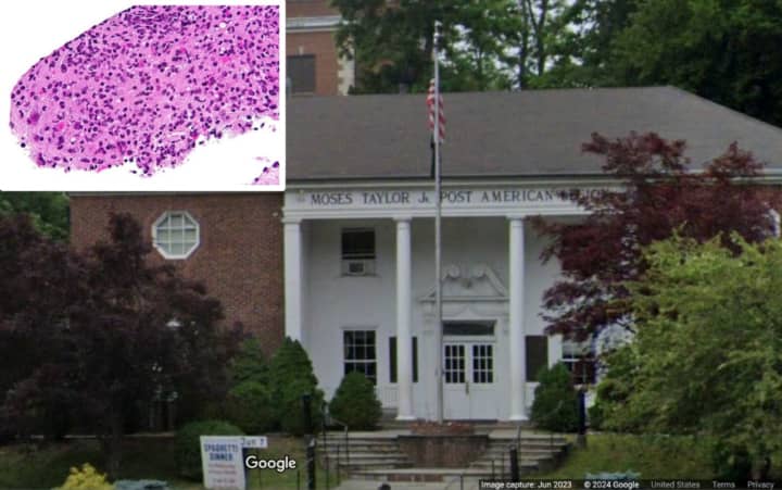 People infected with&nbsp;toxoplasmosis attended two game dinners held at the&nbsp;Moses Taylor Jr. American Legion Post in Mount Kisco.   
