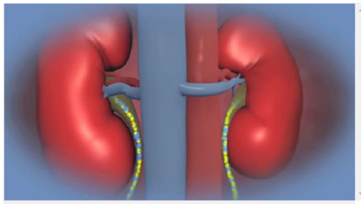 Researchers are encouraged by success they&#x27;ve seen in patients who received kidneys from incompatiable donors.