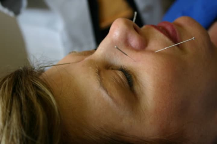 Jim Fitzpatrick, a Fairfield acupuncturist who works in Wilton, said patients can get relief from anxiety, depression and a whole host of other physical issues with acupuncture. 