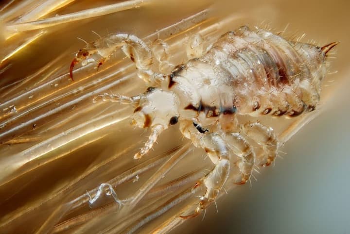 Head lice that is resistant to common treatments have spread to 28 states, including Connecticut.